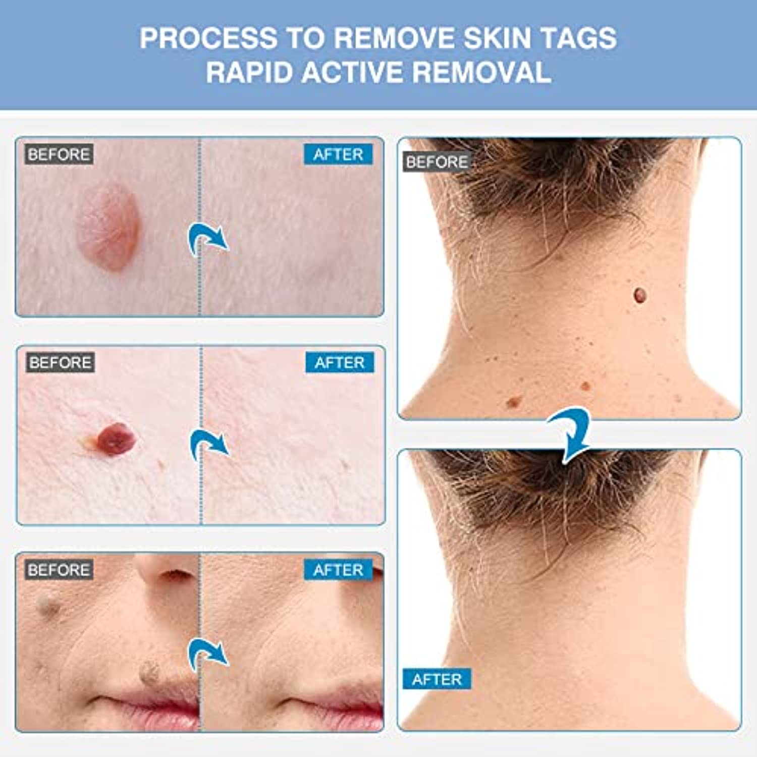 Skin Tag Remover, Skin Tag Removal Kit Tools for Small to Medium Skin Tags, Easy Application Device, Safe and Painless, Suitable for All Body Parts