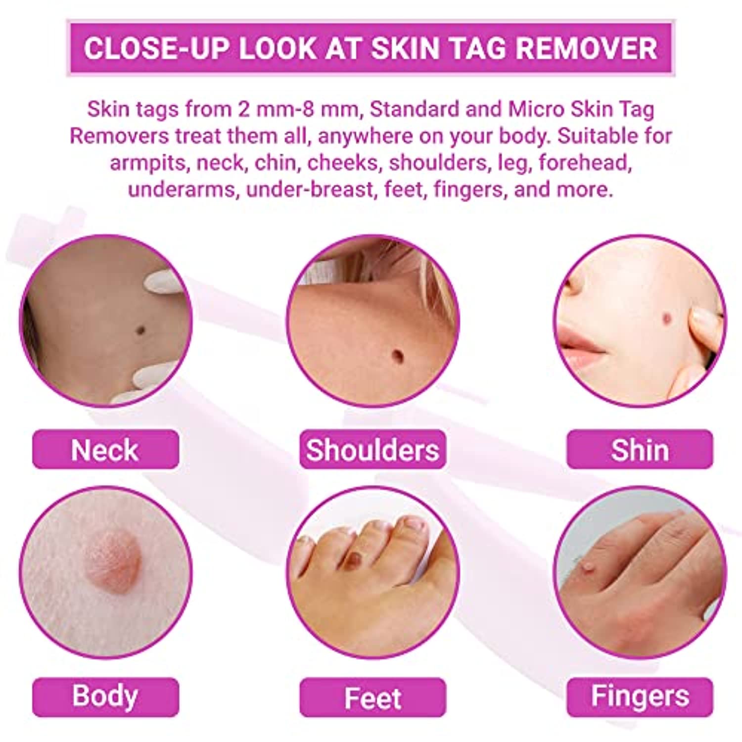Skin Tag Removal Kit, Small & Standard Skin Tag Remover Device, 36 Pc Repair Patches, Skin Tag Remover Kit for Small and Large Skin Tags (2mm to 8 mm), for Body, Face, Neck, Finger, Arm, Easy, Safe