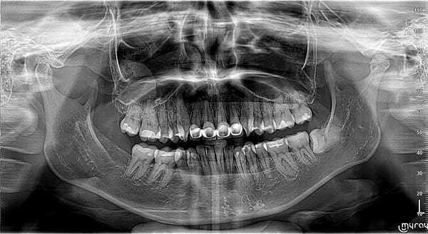 Fig 7: Extraoral radiograph of the patient (OPG view)