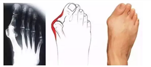hallux valgus