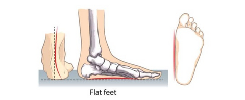 Plattfüße