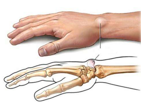 Tenosynovitis?