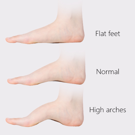 Flat feet/Low arch – BangniStep