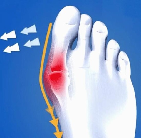 Overpronation/Supination – BangniStep