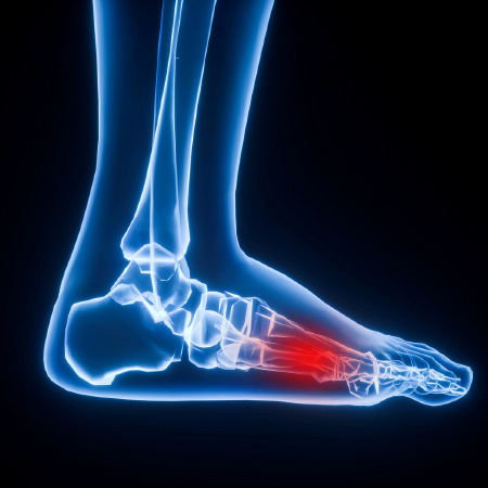 Ball of foot pain/Metatarsalgia – BangniStep