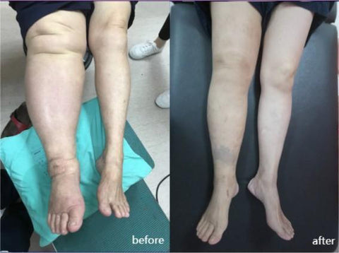 ThermaFlex™ Compression Knee Brace-Relieves Lower Limb Edema and Arthritis