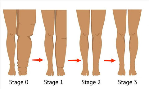 ThermaFlex™ Compression Knee Brace-Relieves Lower Limb Edema and Arthritis