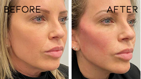 InstaLift Korea Protein Thread Lifting Set