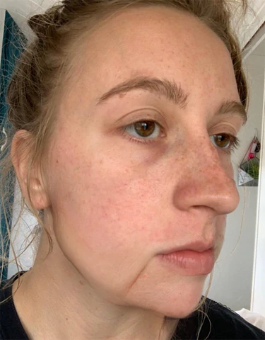 InstaLift Korea Protein Thread Lifting Set