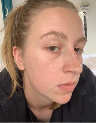 InstaLift Korea Protein Thread Lifting Set