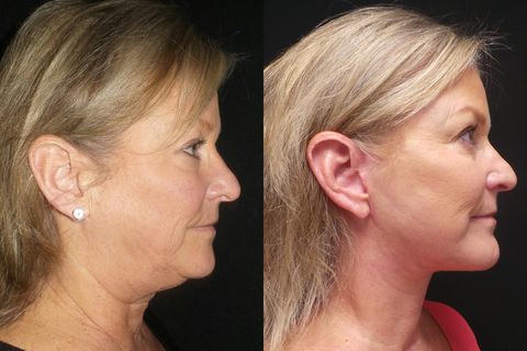 PreSlim 2 in 1 Adjustable MagneticTherapy Transforming Bracelet Ring