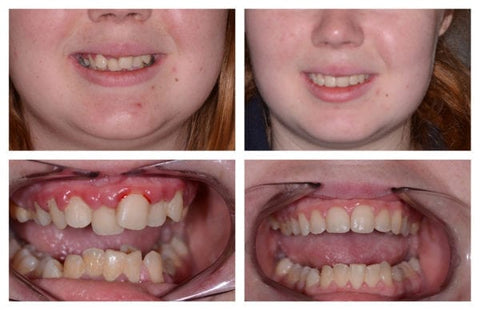 Teethyouth Tooth Regrowth Gel 