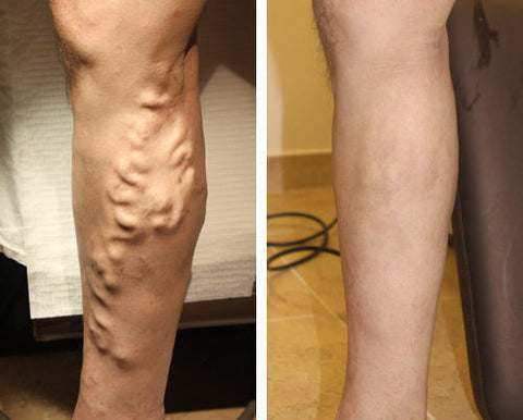 AFIZTM Tourmaline Lymphvity Varicose Veins Treatment Sock