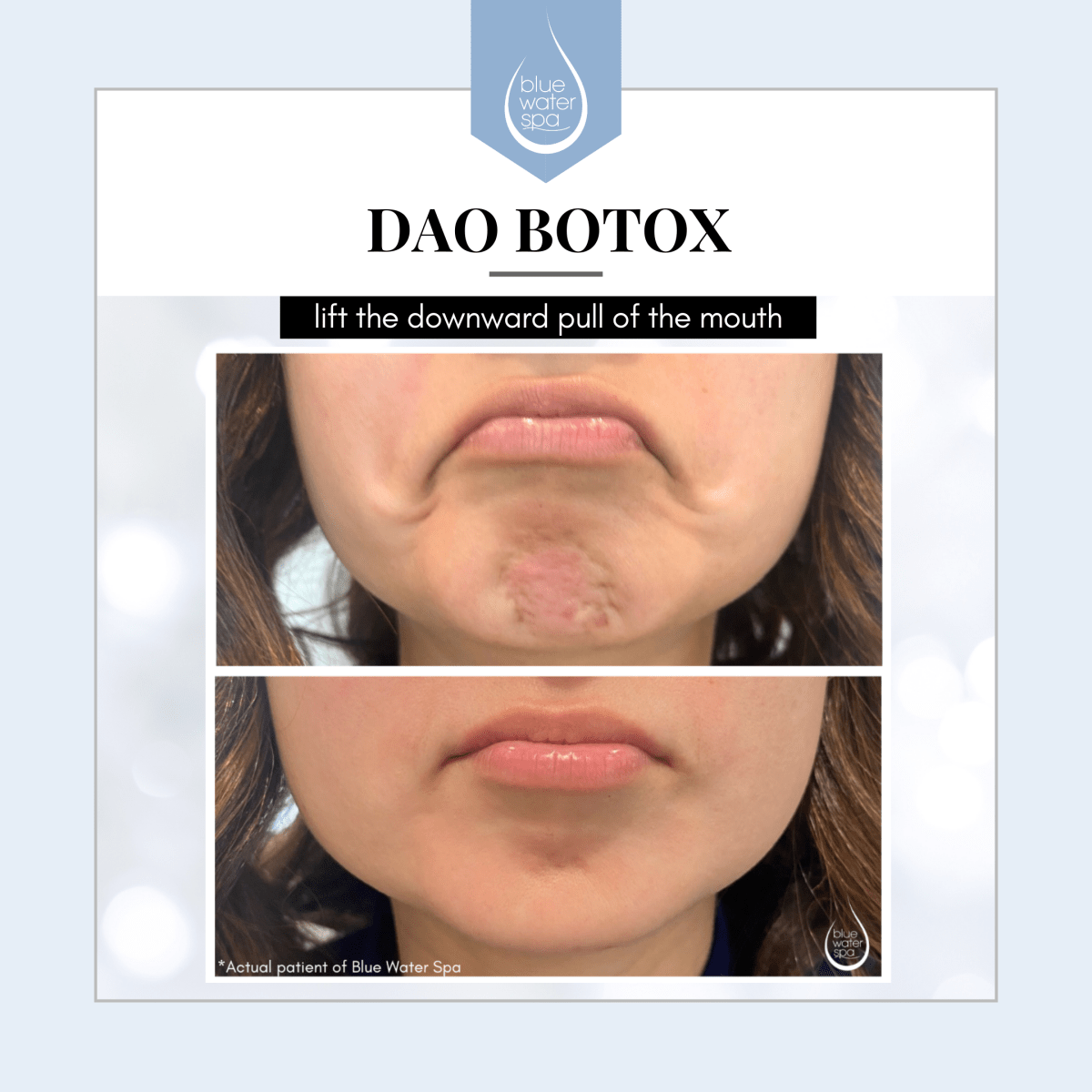 Botox for DAO Lines