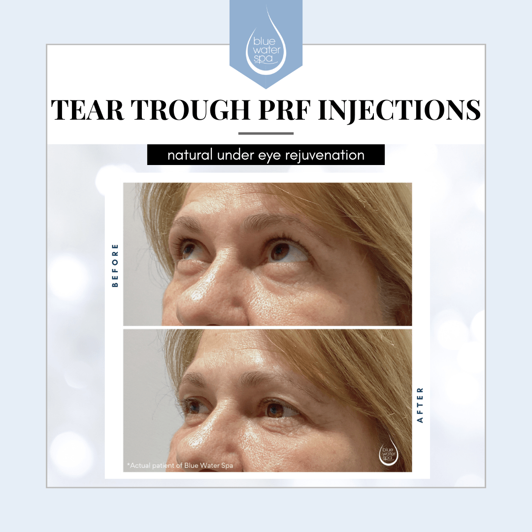 PRF Injections of the Tear Troughs