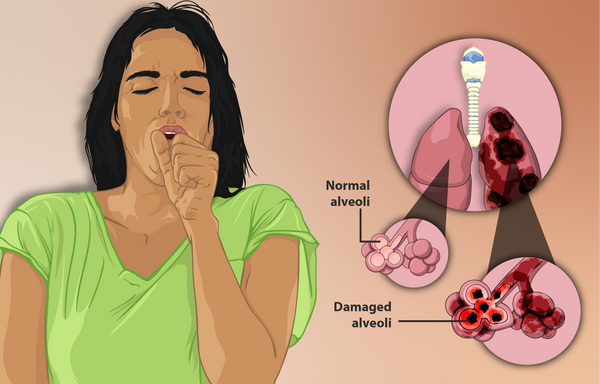 www.dedakjoxygenconcentrators.com-Depiction_of_a_woman_suffering_from_Emphysema,_a_type_of_Chronic_Obstructive_Pulmonary_Disease