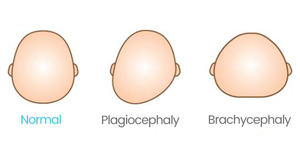Plagiocephaly and Brachycephaly