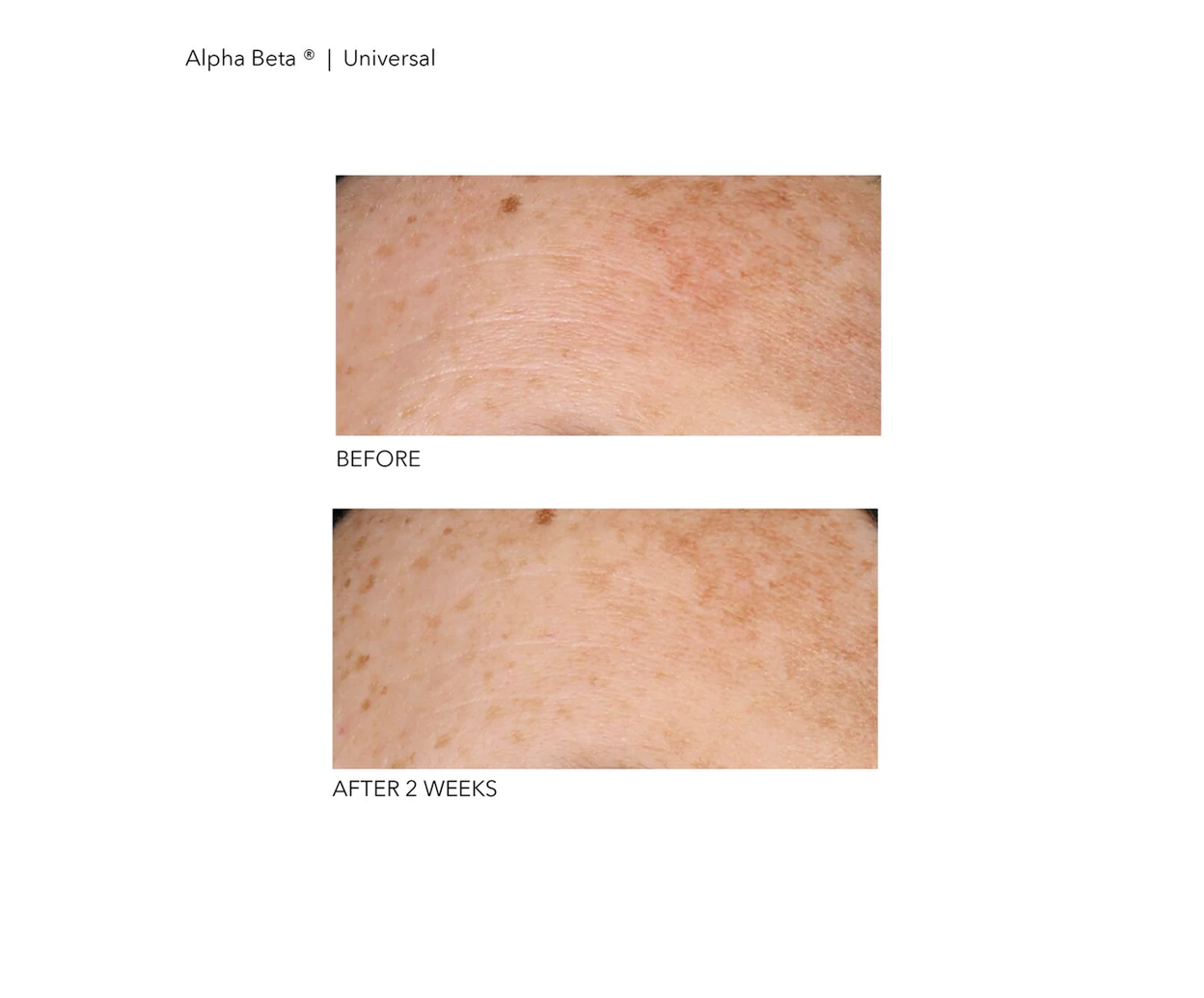 Alpha Beta? Universal Daily Peel