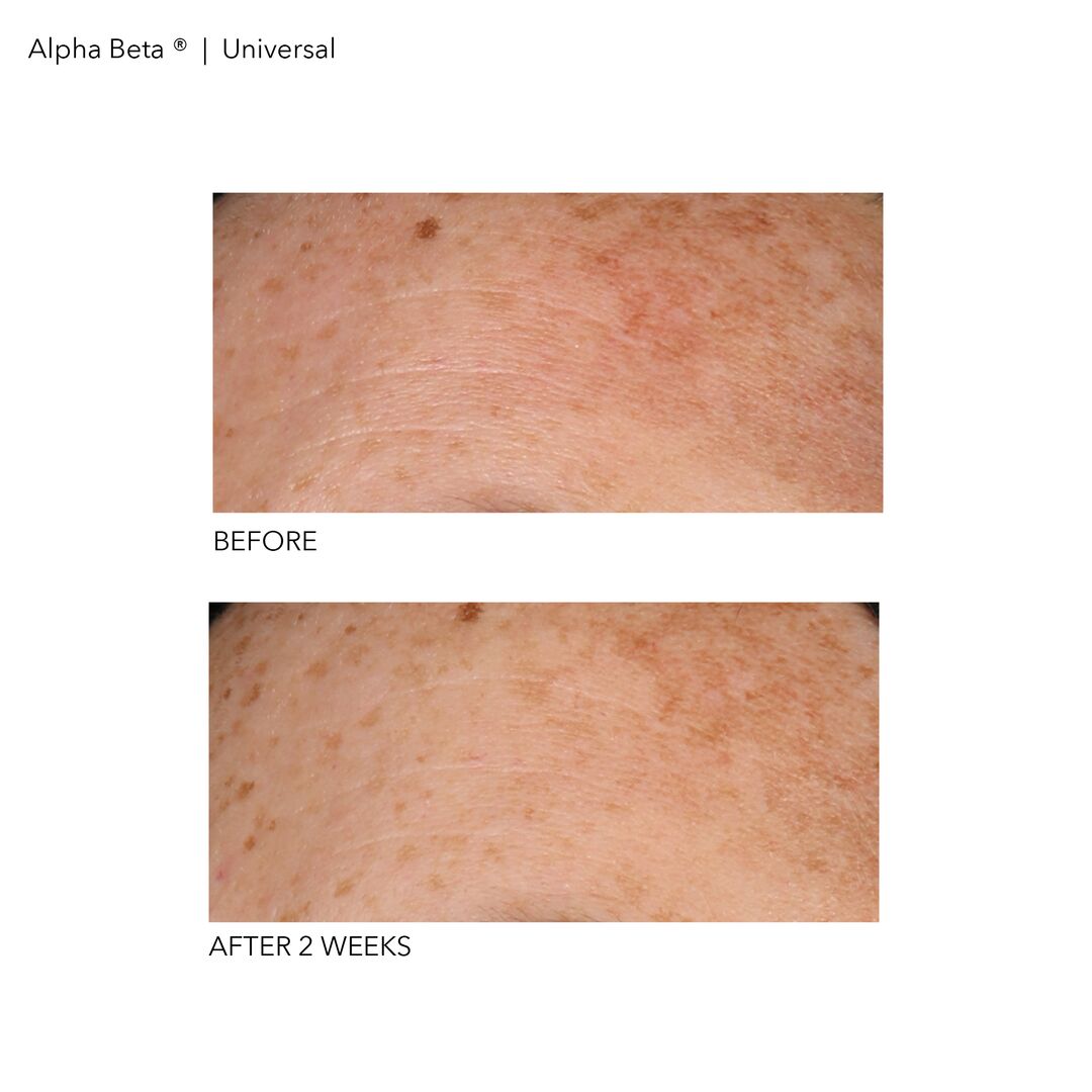 Alpha Beta? Universal Daily Peel