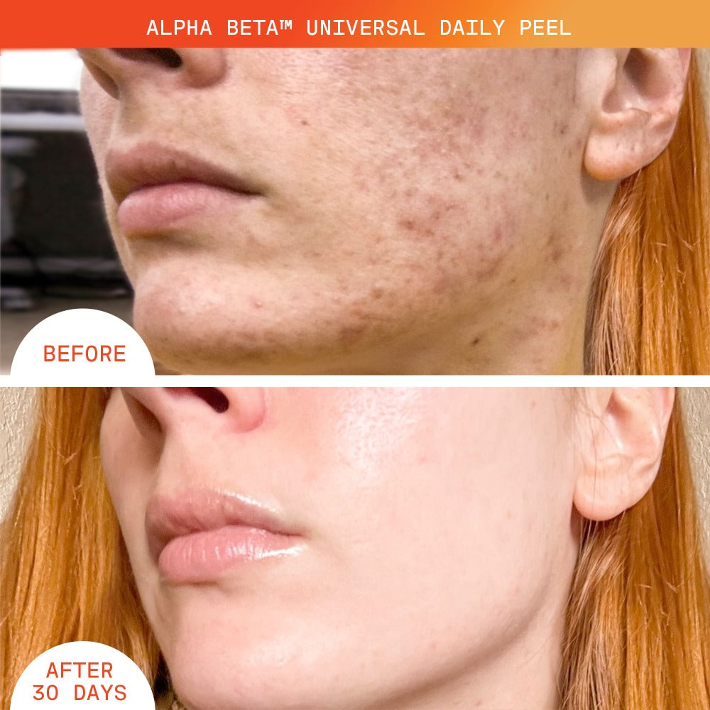 Alpha Beta? Universal Daily Peel