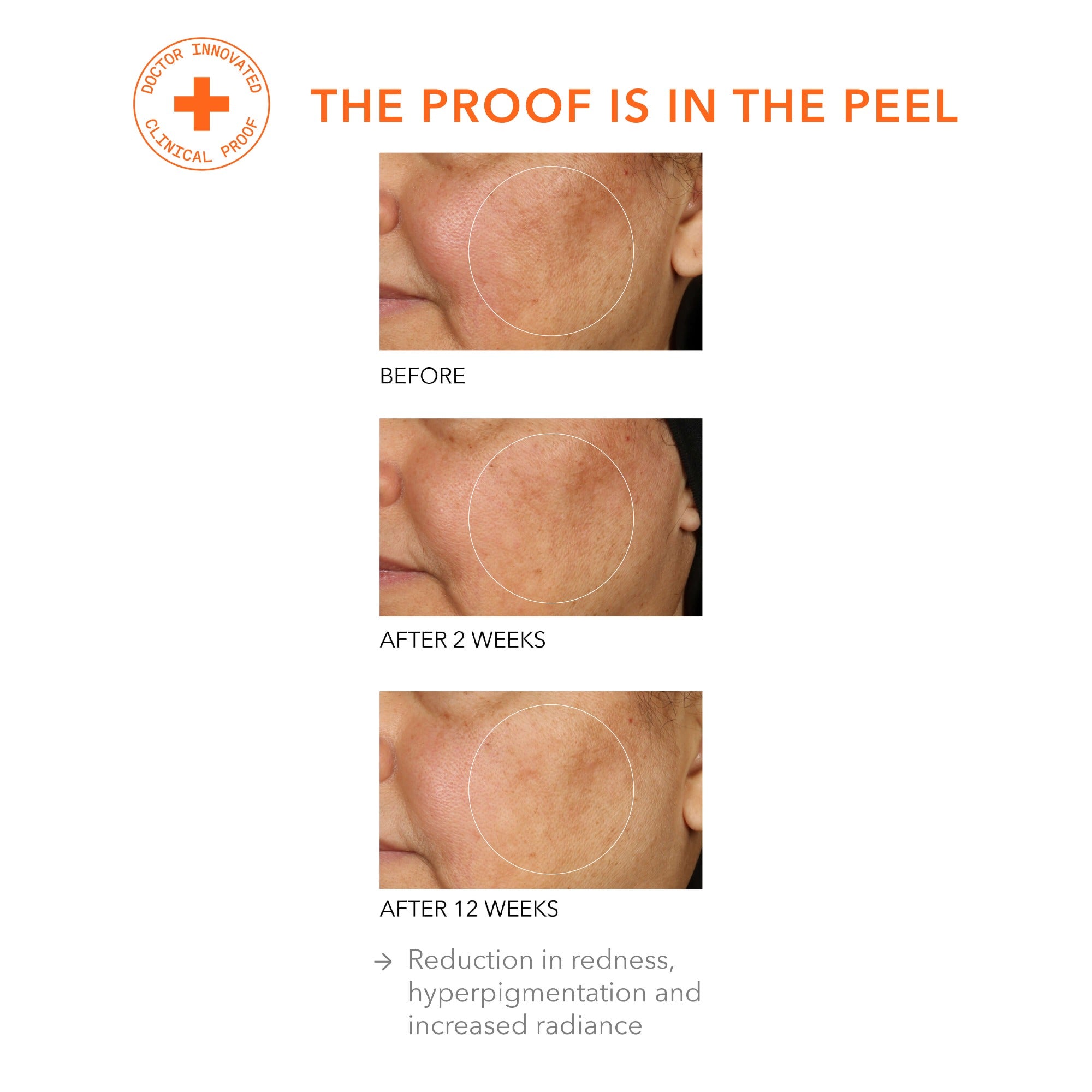 Alpha Beta? Universal Daily Peel