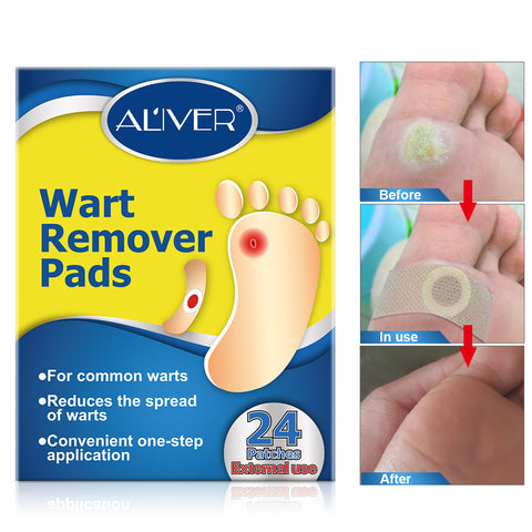 wart on foot pad