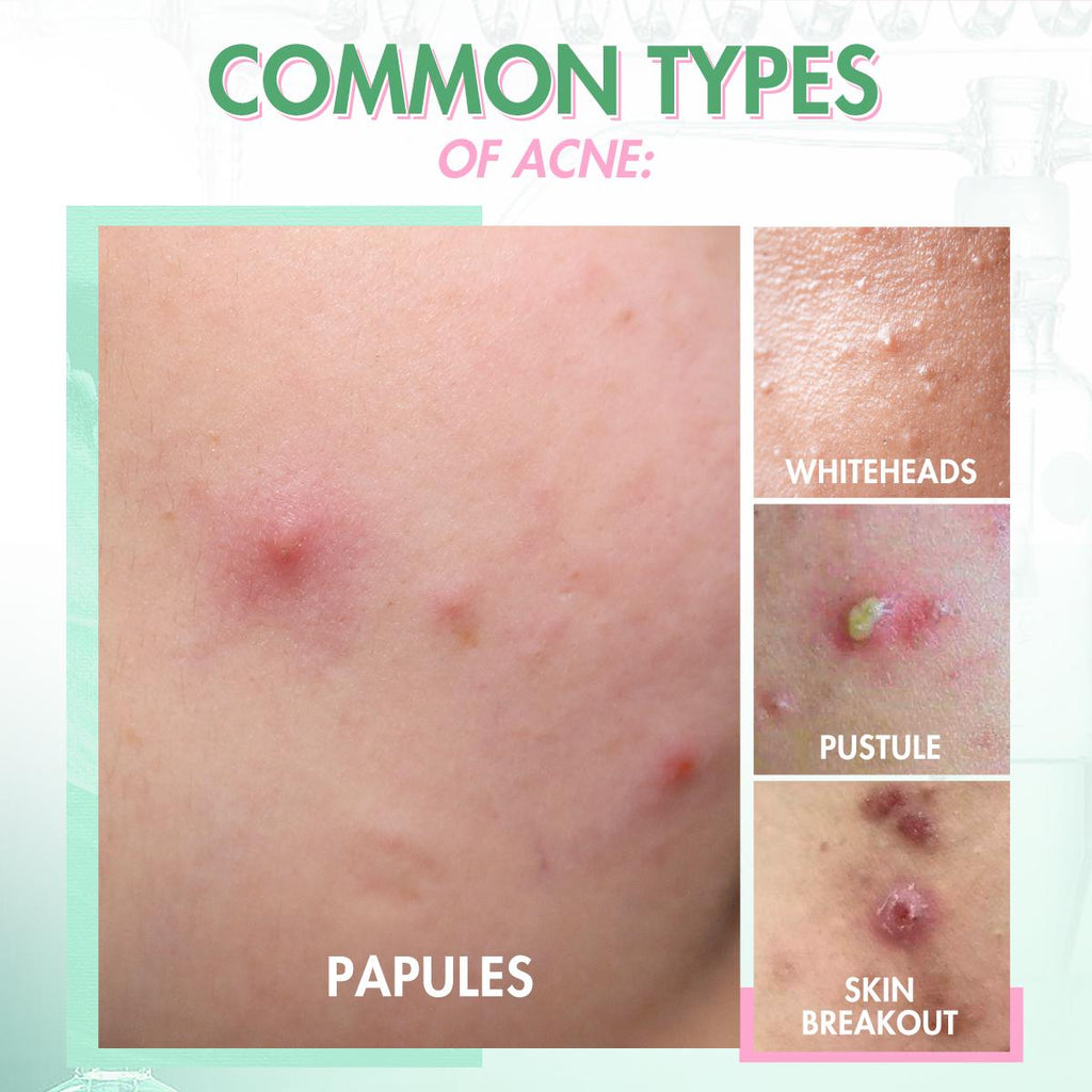 NEW ARRIVAL: Pimple Warrior--The Best Acne Spot Treatment to Get Rid o
