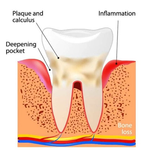 Plaque and calculus, inflammation and deepening pocket. | Cheeeese