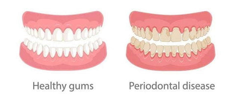 Difference between healthy gums and periodontal disease. | Cheeeese