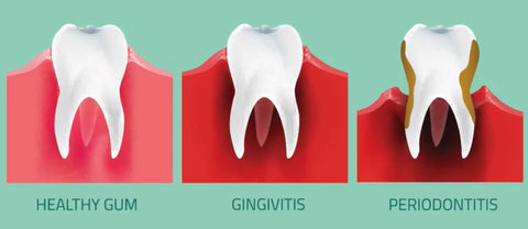 Different levels of healthy gum, gingivitis and periodontitis | Cheeeese