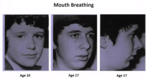 Mouth breathing can hurt our face, It can have a negative impact even on our cheekbones development and how the length of our face can change. | Cheeeese