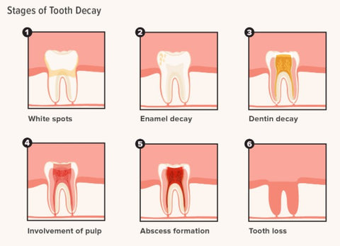 Six stages of tooth decay, white spots, enamel decay, dentin decay, involvement of pulp, abscess formation and tooth loss. | Cheeeese 