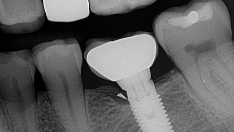 Cheeeese-Can dental implants break? Placing the implant at the right depth is important.