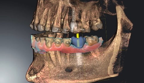 Cheeeese-Can dental implants break? not only is the titanium holding together, but the bone is holding it together.