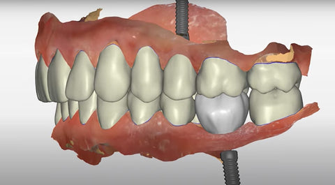 Cheeeese-we place an implant at the proper depth so we get it fully buried in bone and we races bite back up and then we put a new crown on it.