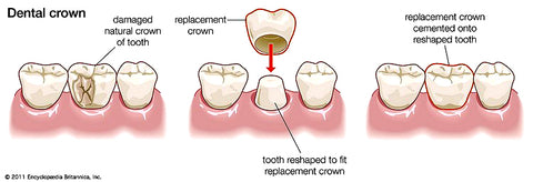A cracked tooth or crown can cause tooth pain and tooth sensitivity. | Cheeeese