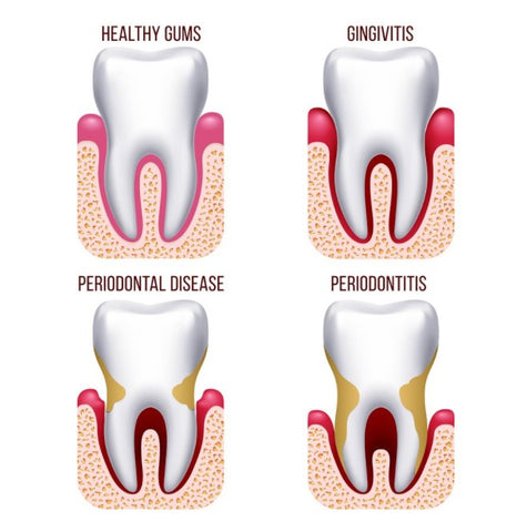 Stages of healthy gums, gingivitis, periodontal disease and periodontitis. | Cheeeese 