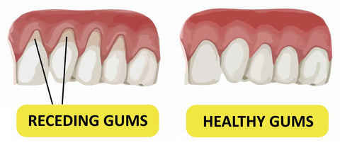 Second reason for tooth pain is gum recession | Cheeeese 