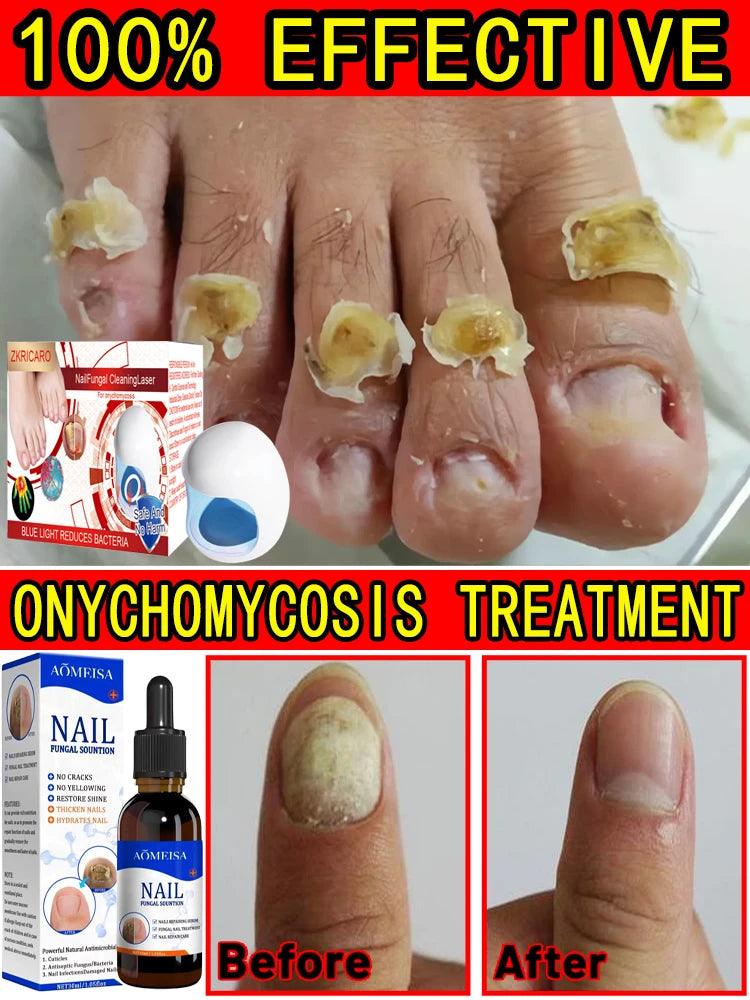 Fungal Nail Laser Device Repair Nails Fungus Onychomycosis