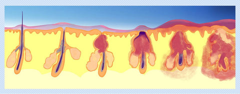 microdermabrasion skin scrubber