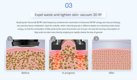 vacuum RF body sutcion
