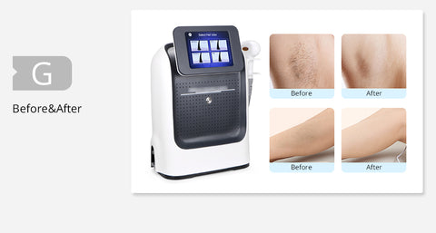 permanent hair removal