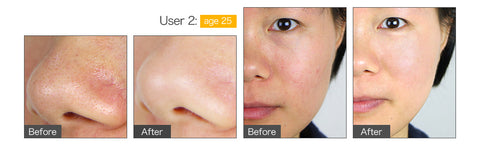 microdermabrasion before and after use spa(