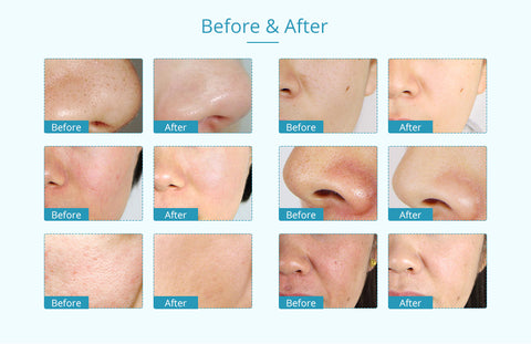 microdermabrasion machine
