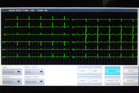 3 channel ECG machine waveform