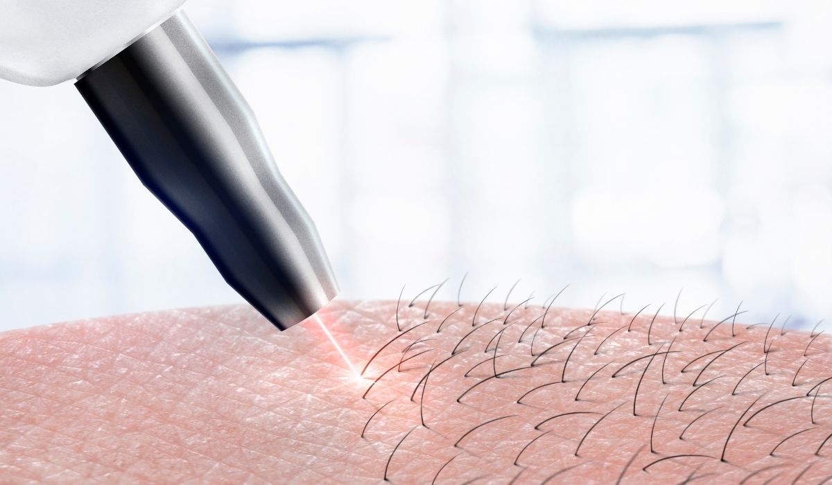 Laser hair removal on body parts