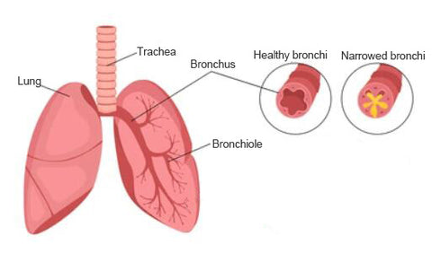 COPD