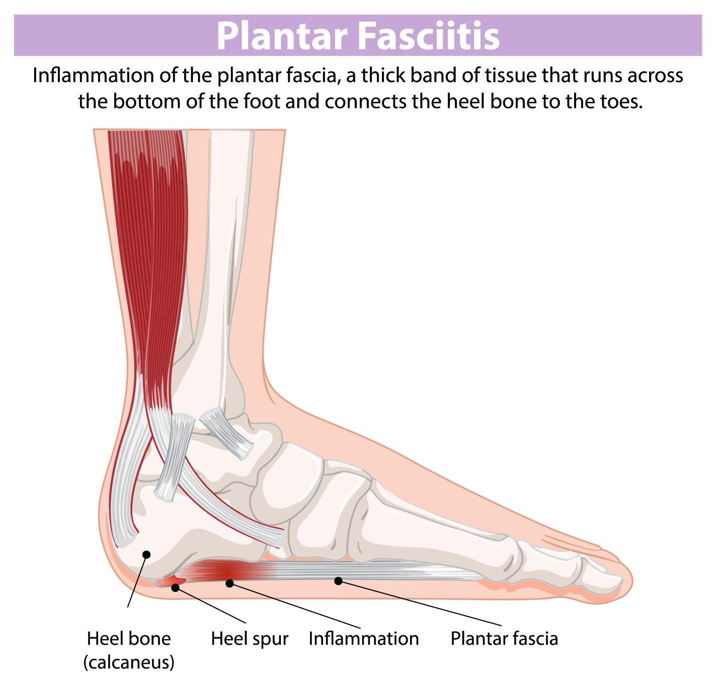 Fivali Plantar Fasciitis -Guide