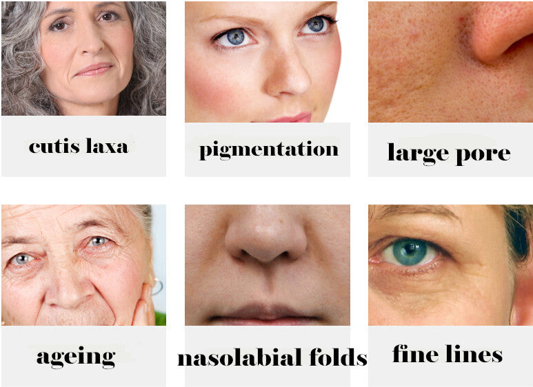 Otesaly Mesotherapy