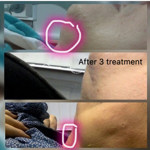 Otesaly Lipolysis Meso Injection